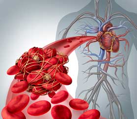 Blood Clot Treatment in West Hollywood, CA